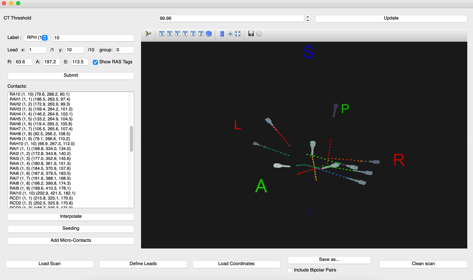 VoxTool electrode localization window with contact coordinates, no identifiers
